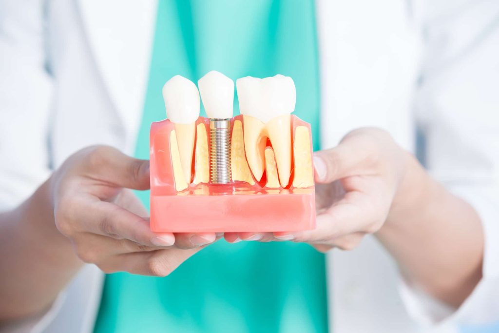 Can Smokers Get Dental Implants Safely