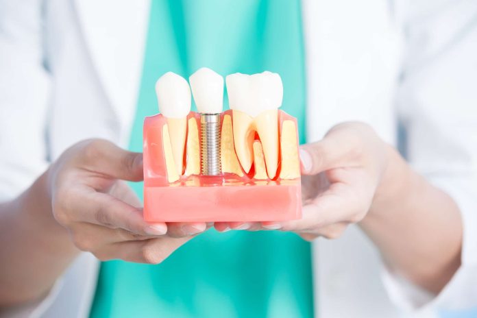 Can Smokers Get Dental Implants Safely
