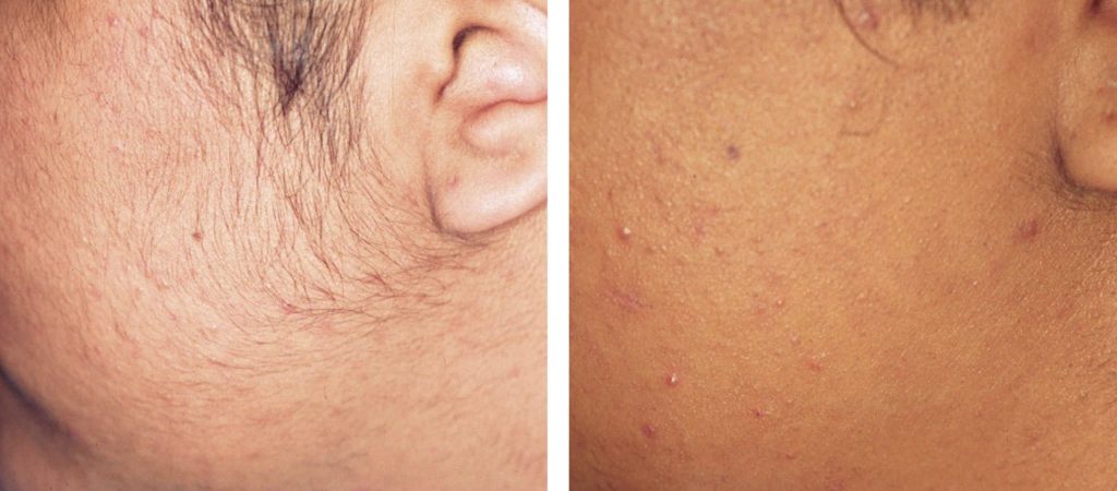 Electrolysis Hair Removal in Dubai