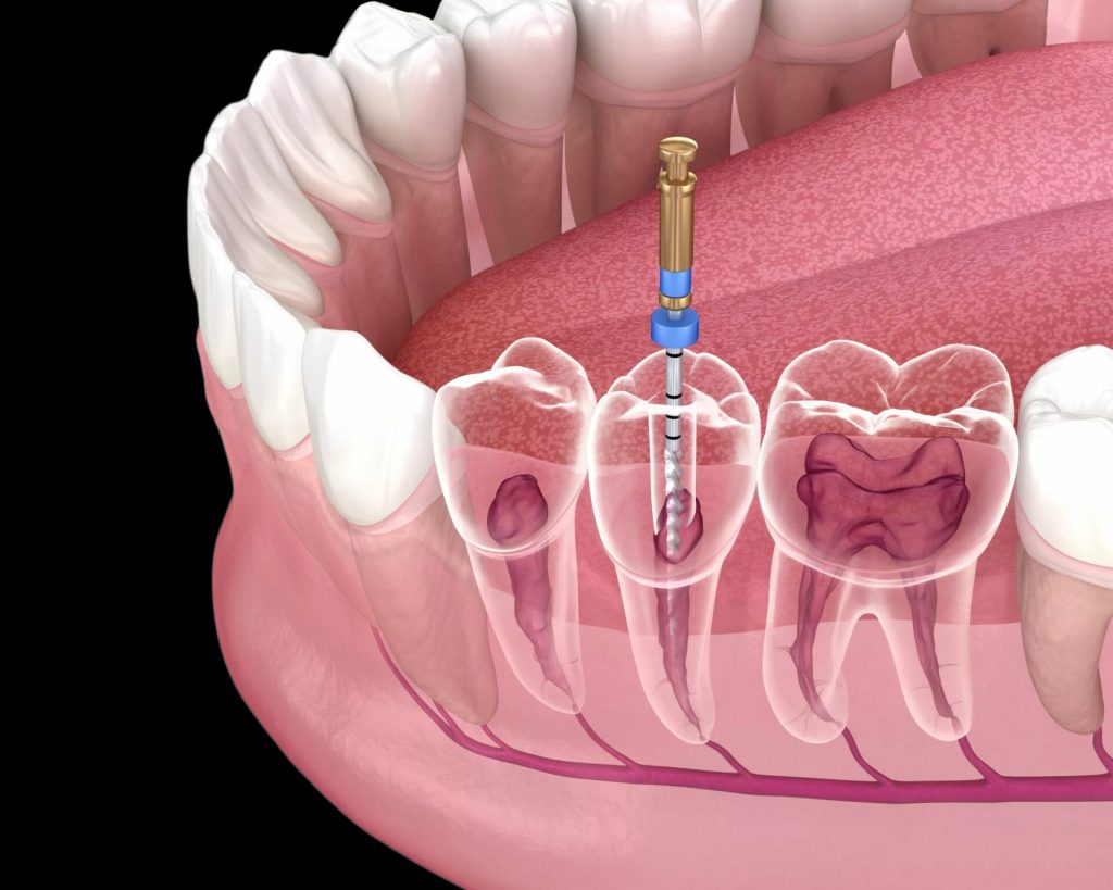 Root canal treatment in Islamabad
