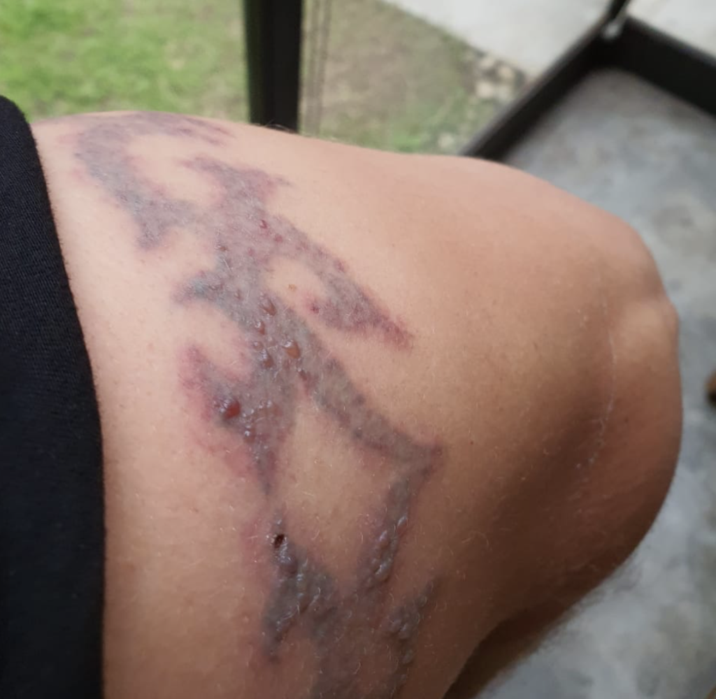 Signs of Injury After Laser Tattoo Removal and Proper Skin Care