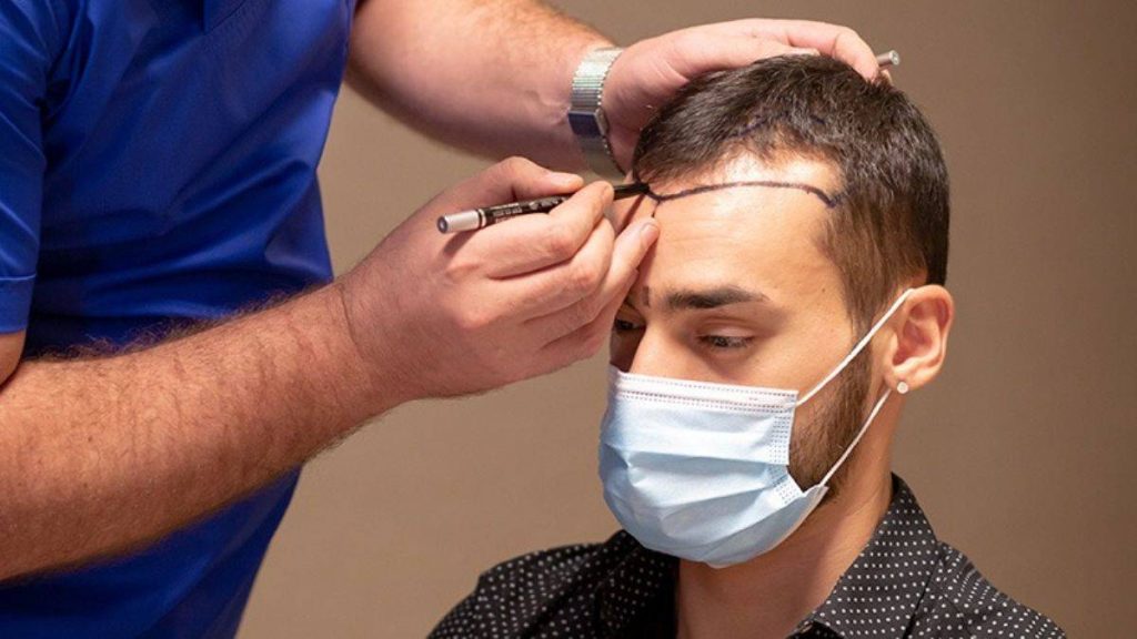 Hair Transplant in Islamabad pakistan