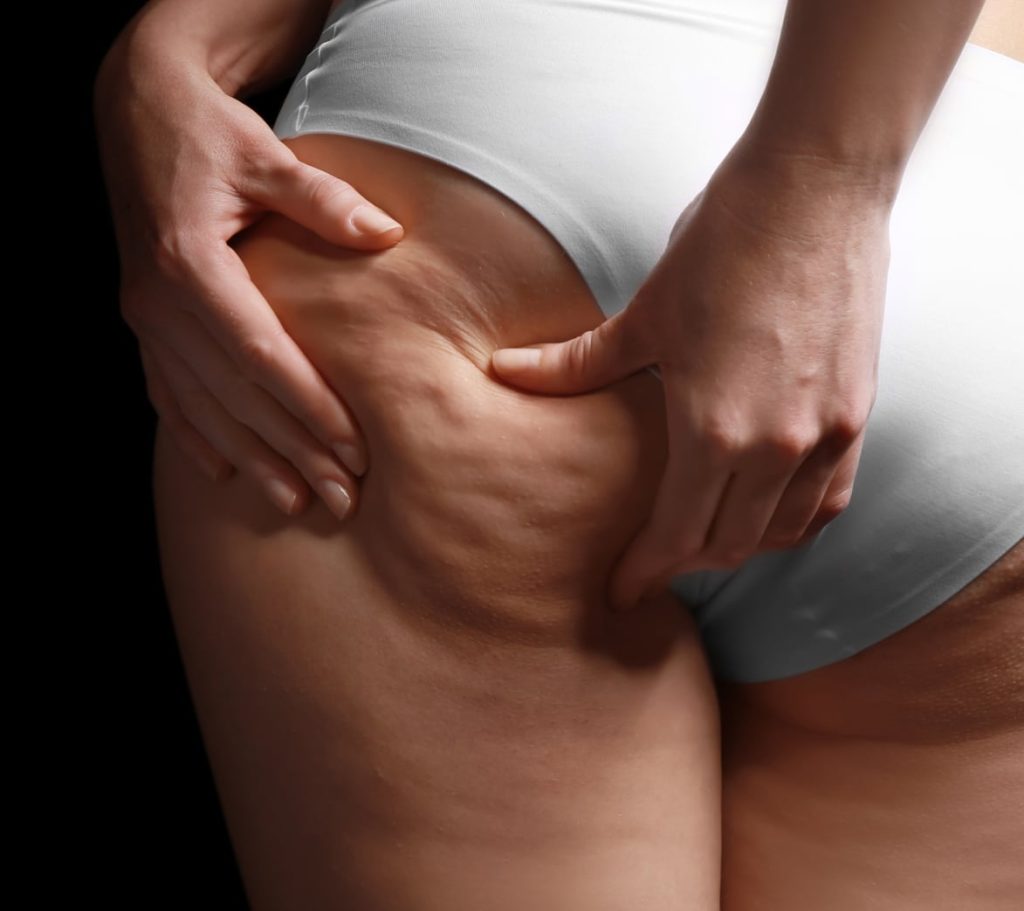 How to Maintain Results After Cellulite Removal