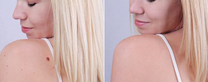 Warts Removal in Islamabad