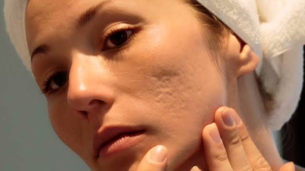 Acne Scars Treatment in Islamabad