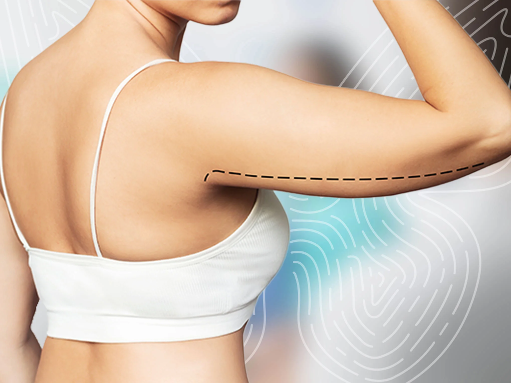 Brachioplasty: How Long Do Results Really Last