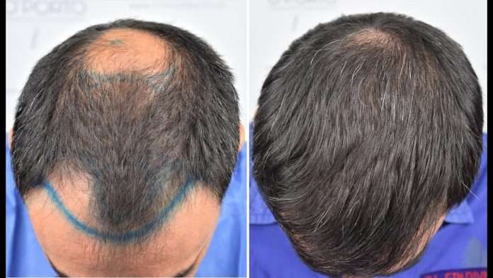 Crown hair transplant in Islamabad