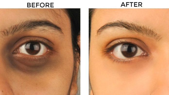 Dark Circles Treatment in Islamabad