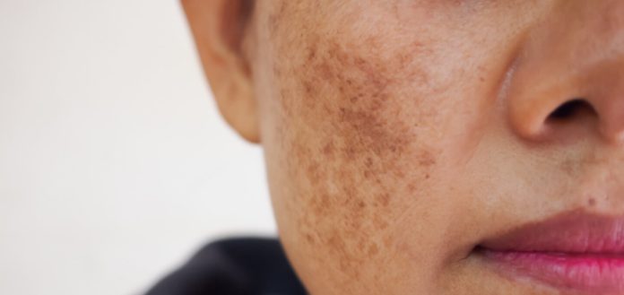 Melasma Treatment in Islamabad