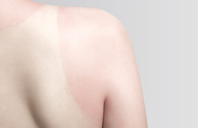 Scalp repair with reconstructive burn surgery