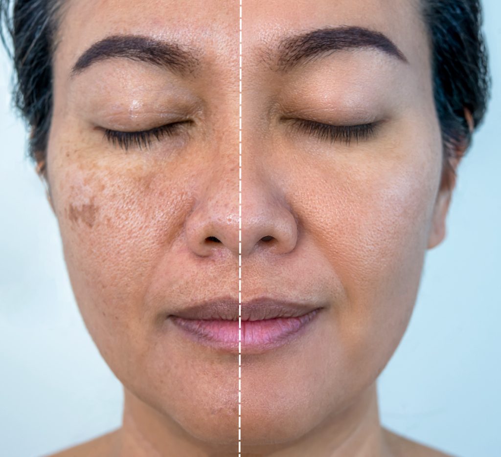 Melasma Treatment in Islamabad
