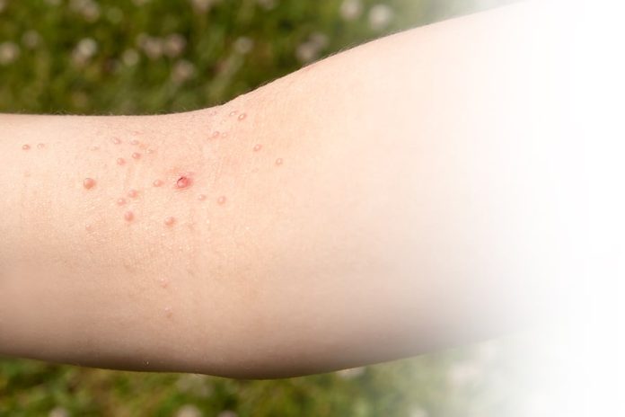 Best Recovery Tips After Warts Removal Surgery