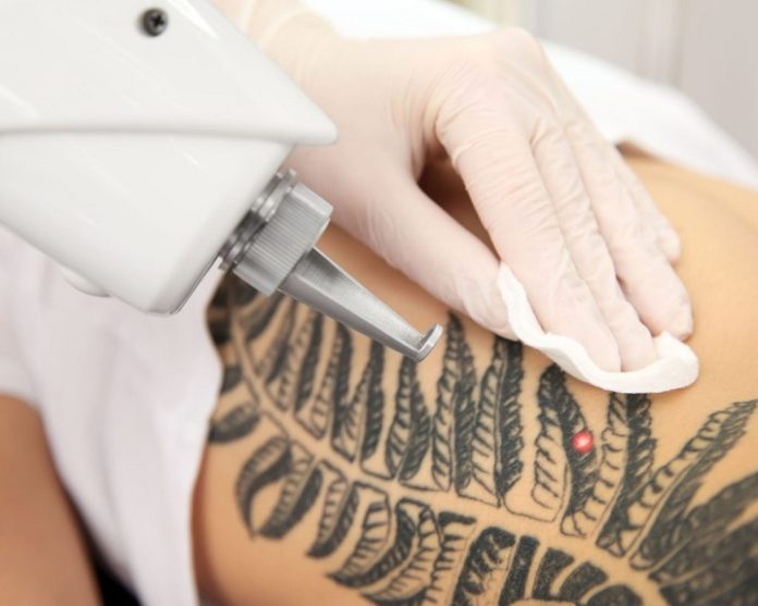 Laser Tattoo Removal: Can It Remove Colored Ink