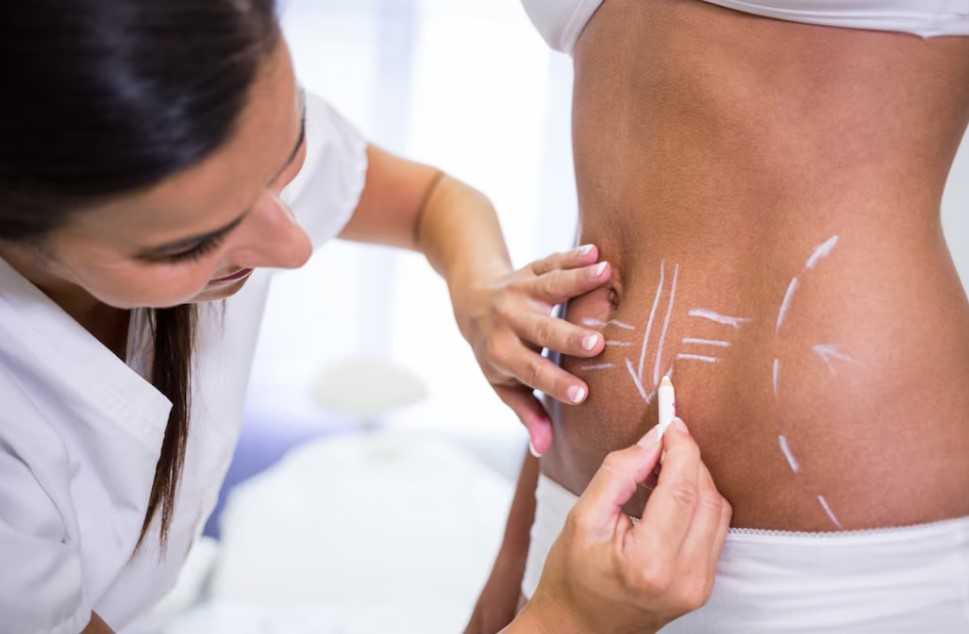 Liposuction in Islamabad