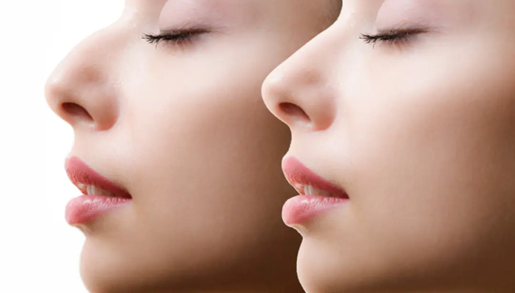 Non Surgical Rhinoplasty: Enhance Your Features Safely