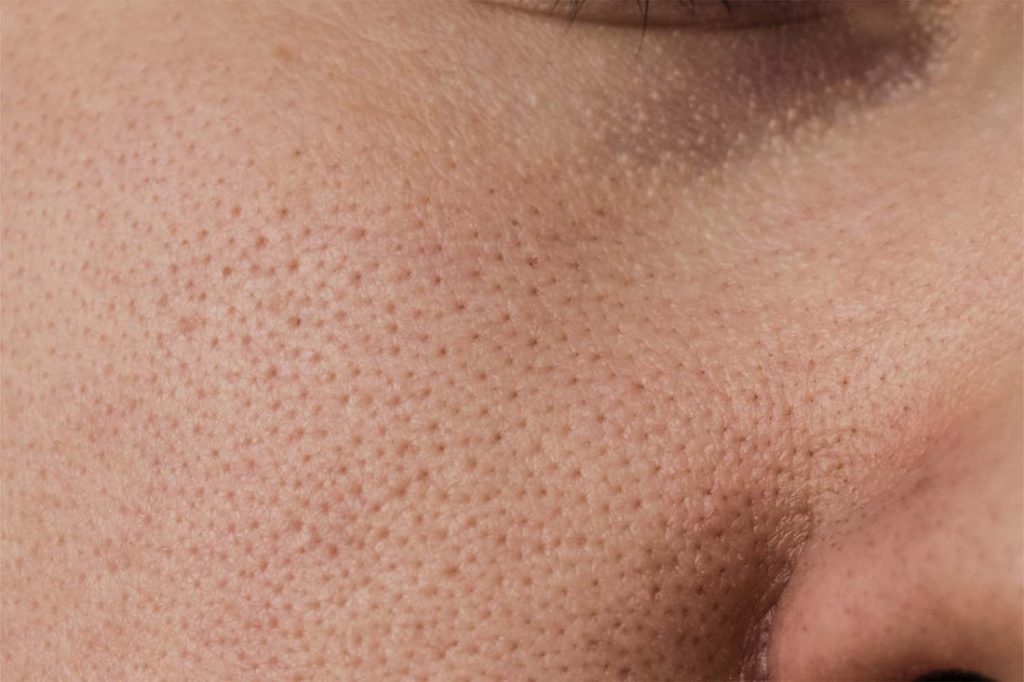 Top dermatologist picks for large pores treatment