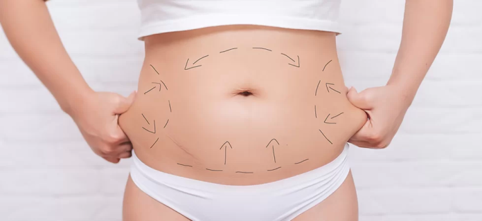 Tummy Tuck in Islamabad